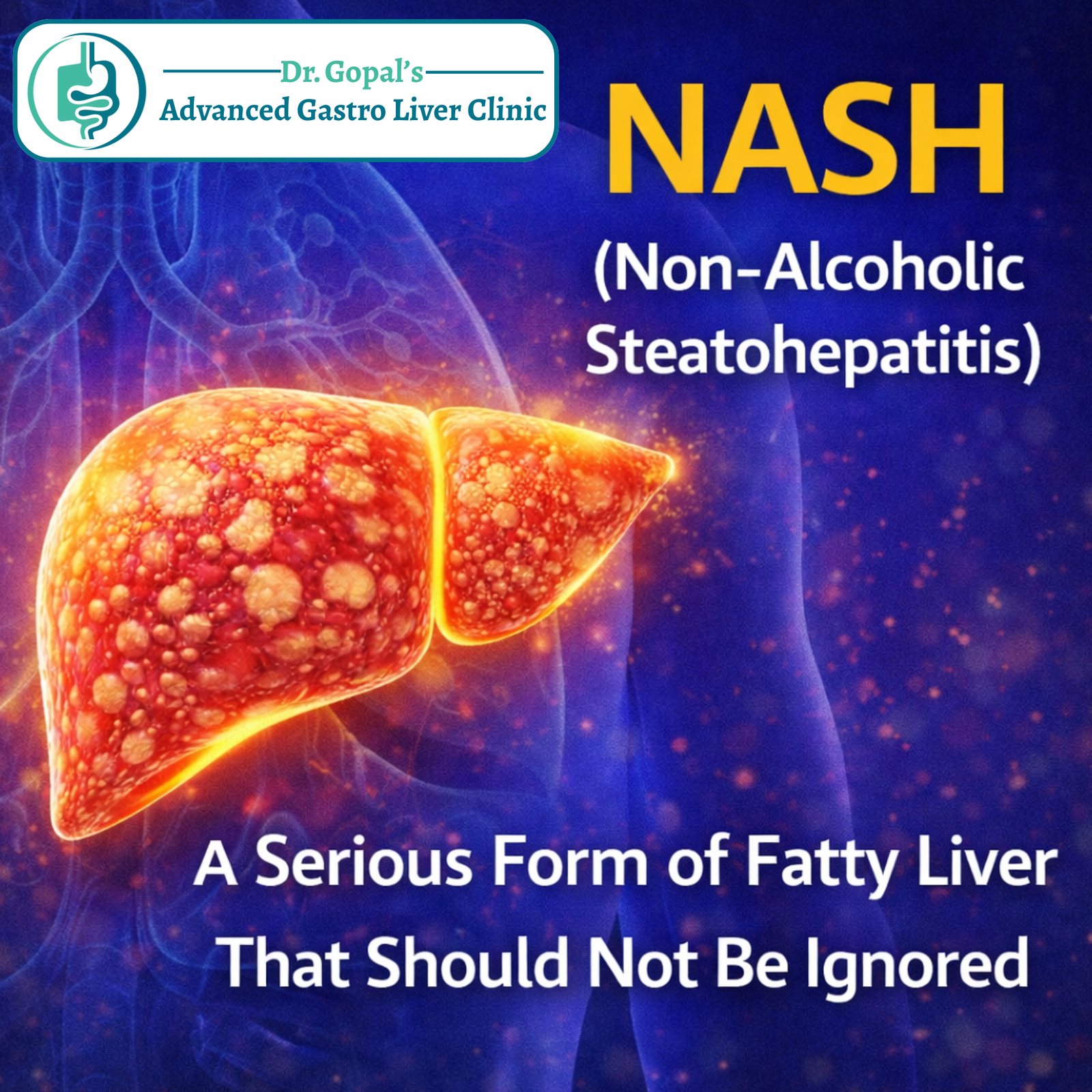 NASH (Non-Alcoholic Steatohepatitis): A Serious Form of Fatty Liver That Should Not Be Ignored -By Dr. Gopal Sharan Singh, DM Gastroenterologist